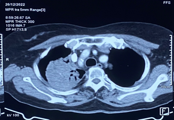 Những loại thuốc điều trị ung thư phế quản phổi nguyên phát- Ảnh 1.