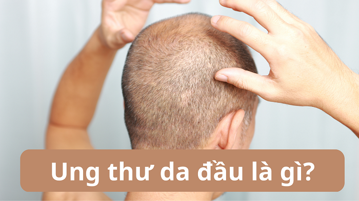 Ung thư da đầu: Nguyên nhân, triệu chứng, cách điều trị và phòng bệnh- Ảnh 1.