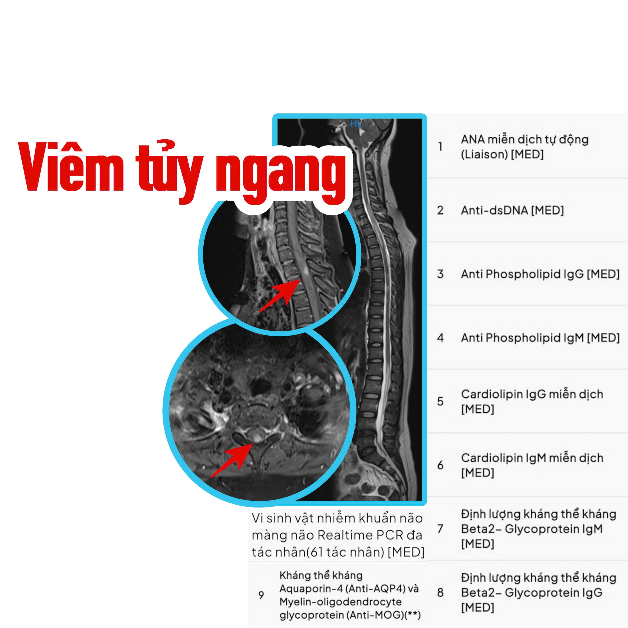 Viêm tủy ngang: Nguyên nhân, triệu chứng, chẩn đoán và cách điều trị- Ảnh 1.